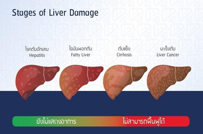 ไขมันพอกตับ ยังไม่แสดงอาการ