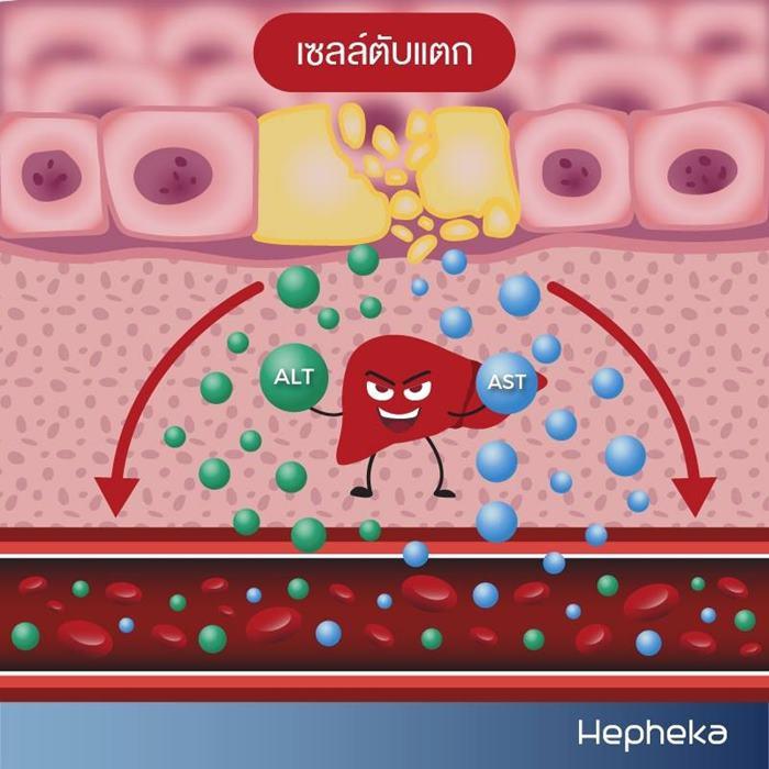 เซลล์ตับแตกเสี่ยง มะเร็งตับ