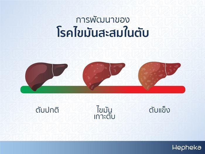 ไขมันพอกตับเกิดจาก ไขมันสะสมในตับ
