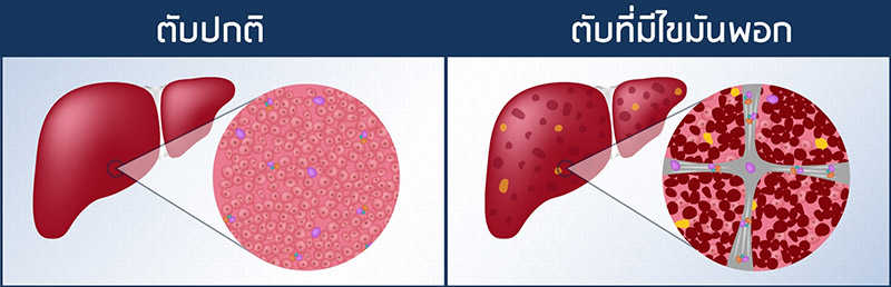 ตับที่มี ไขมันพอกตับ
