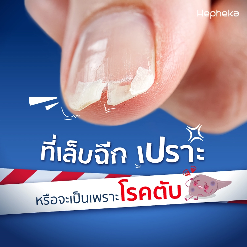 เล็บฉีก