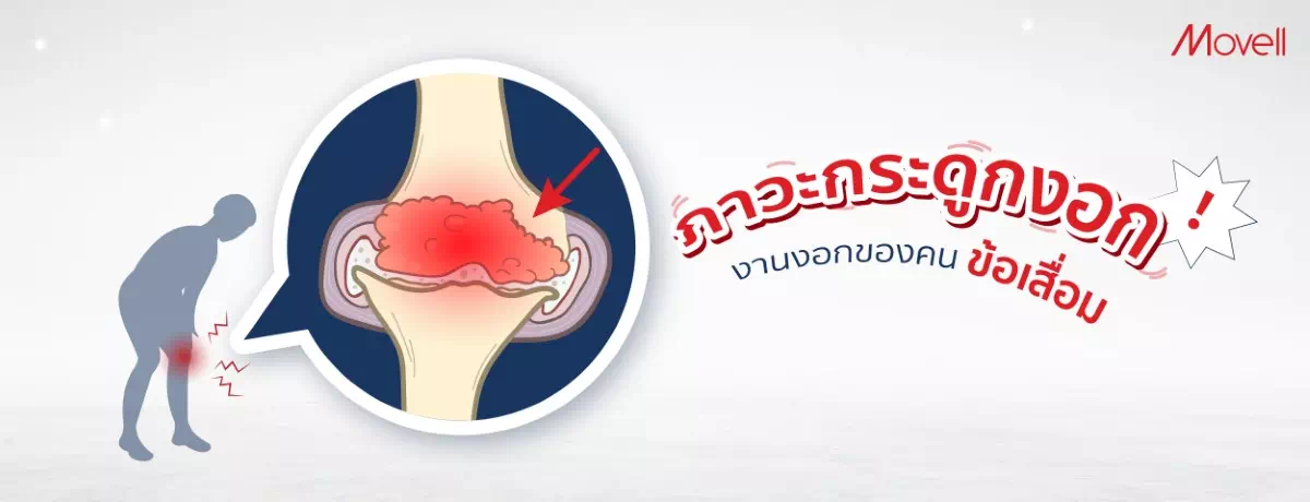 ภาวะกระดูกงอก งานงอกของคนข้อเสื่อม